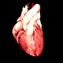 CT Coronary Angiogram