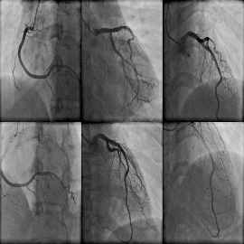 Cardiac Catheterization