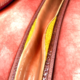 Coronary Calcium Scoring