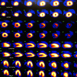 Nuclear Stress Test