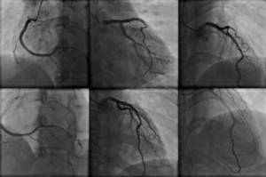 Cardiac Catheterization Beverly Hills