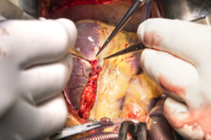 Coronary artery bypass