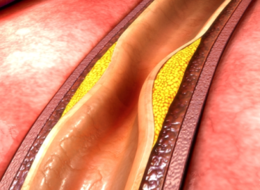 What is a Coronary Calcium Score and Do I Need One?