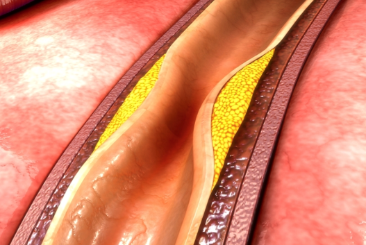 Coronary Calcium Scoring