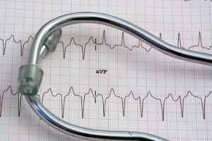 Electrocardiogram