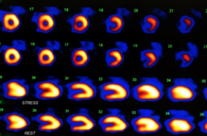 Nuclear Stress Test Beverly Hills