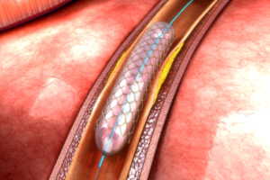 Percutaneous Coronary Intervention