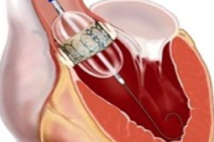 Transcatheter Aortic Valve Replacement Beverly Hills