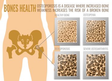 I Have Osteoporosis, What Are My Treatment Options?